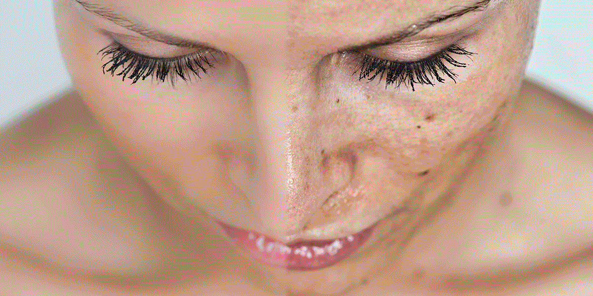 przebarwienia skóry